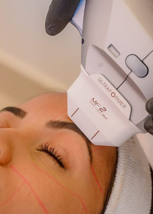 Ultraformer-Fullface-Bio-renew-Clinica-de-Estetica_2-1