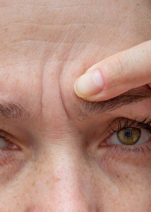 linhas-de-expressão-na-testa